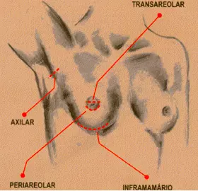 Prótese Mamária